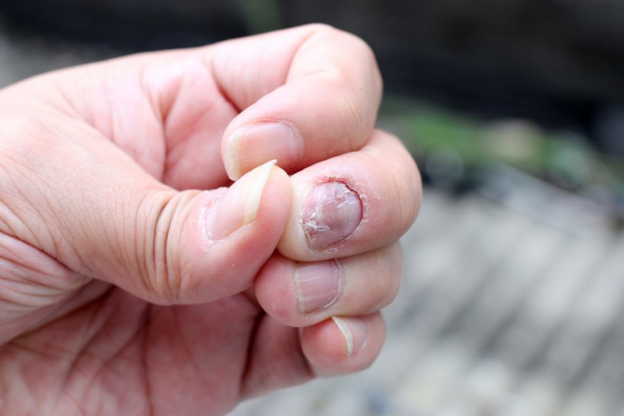 Bạn không nên dùng chung dụng cụ nail để tránh lây nhiễm nấm móng từ người khác
