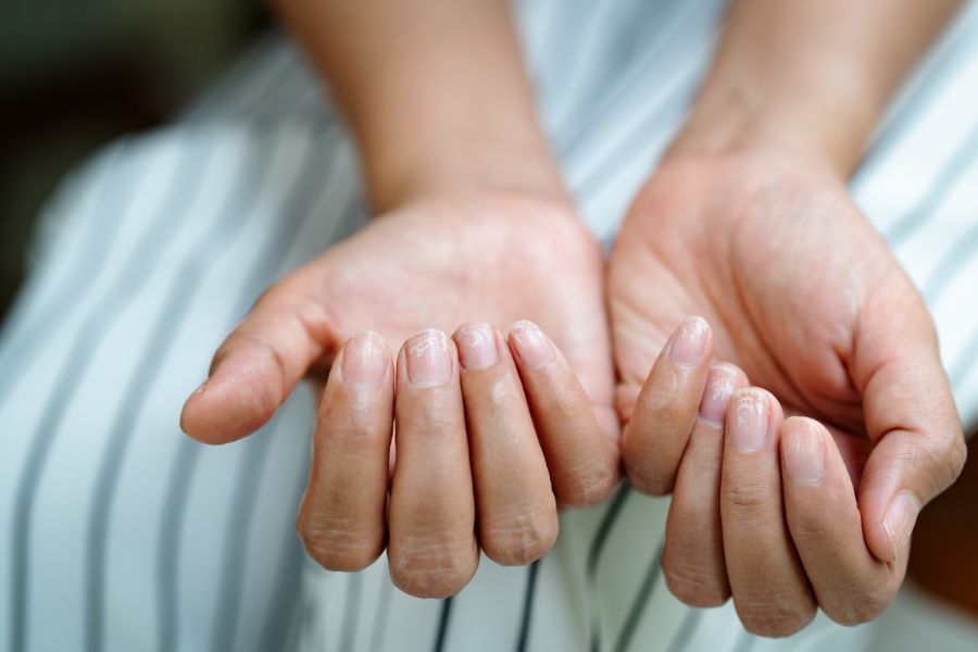 Tìm hiểu những nguyên nhân thường gặp khiến móng tay yếu và dễ gãy