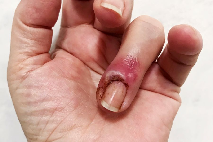 Tuyệt đối không tự ý cắt khoé móng hoặc nặn mủ khi bị viêm da quanh móng