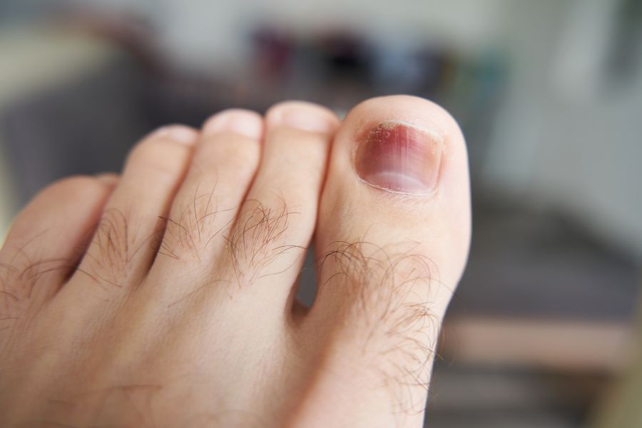 Móng chân bị bầm tím có thể là dấu hiệu cảnh báo sức khoẻ có vấn đề