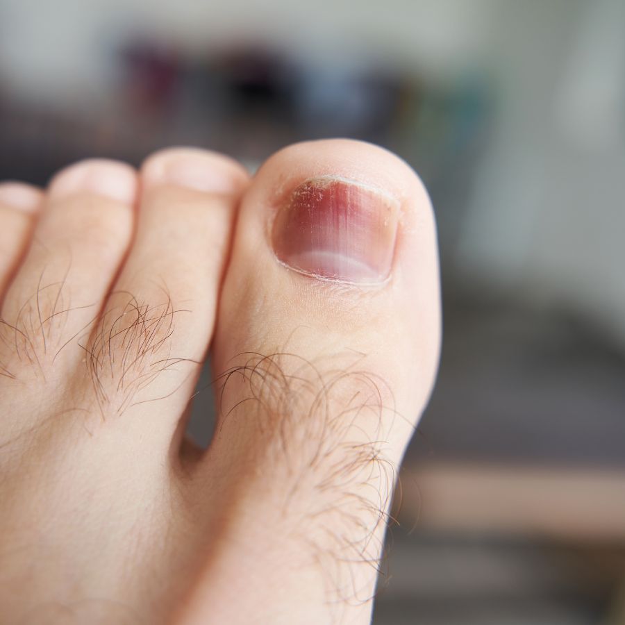 Móng Chân Bị Tím: Nguyên Nhân, Cách Xử Lý Và Phòng Tránh