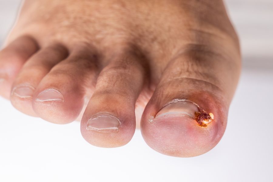 Móng chân bị bầm tím và sưng tấy quanh móng có thể đang bị nhiễm trùng