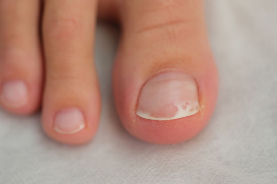 Móng chân bị tổn thương có thể cần từ 6 - 12 tháng để mọc lại hoàn chỉnh