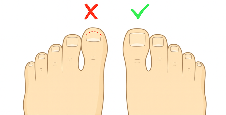 Bạn nên cắt móng ngang (móng vuông) thay vì móng tròn sẽ hạn chế tổn thương móng