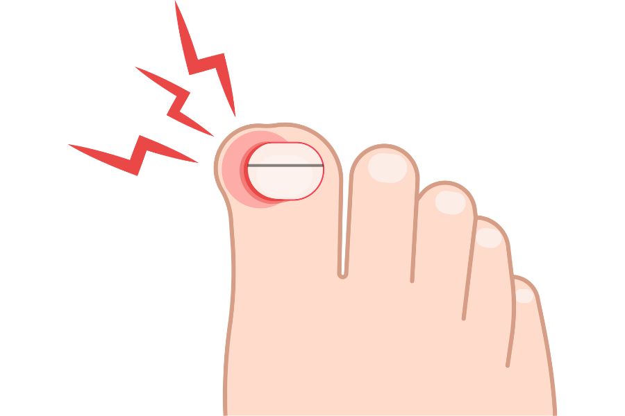 Bạn cần cẩn trọng khi móng chân xuất hiện sọc ngang và có dấu hiệu sưng đỏ