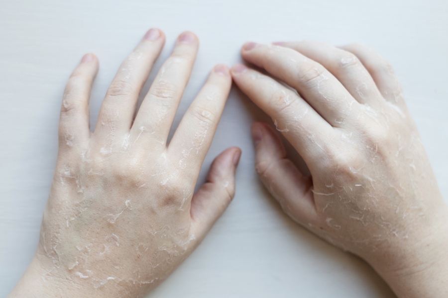 Da tay thiếu độ ẩm và mất nước kéo dài trở nên bong tróc