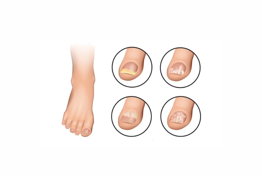 Móng chân bị sọc dọc là hiện tượng sinh lý bình thường