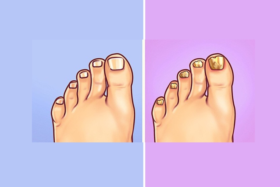Nấm móng và tác nhân ngoài da khiến móng thay đổi bất thường
