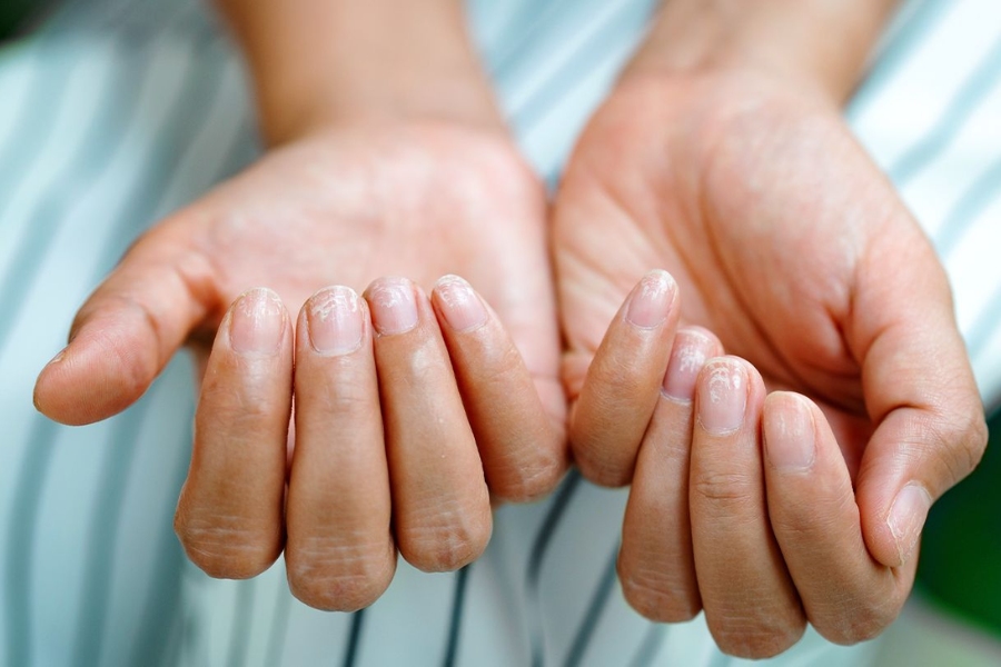 Nấm móng tay là dạng nhiễm trùng do nấm gây ra ở vùng móng