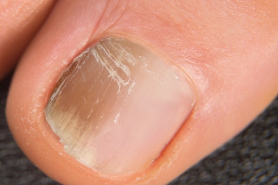 Cần lưu tâm đặc biệt nếu bạn đang gặp tình trạng móng bị sọc