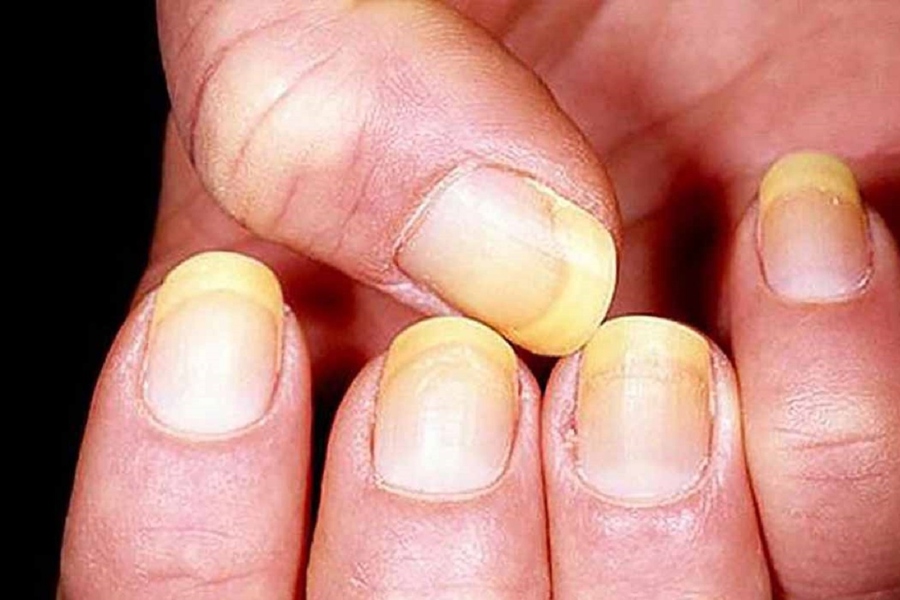 Nấm móng tay có thể chữa khỏi nếu tuân thủ phác đồ điều trị của bác sĩ