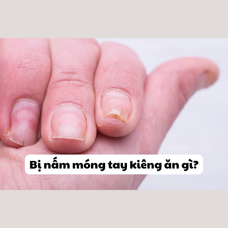 Bị nấm móng tay kiêng ăn gì? Danh sách thực phẩm cần tránh