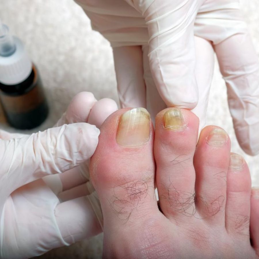 Các bệnh về móng chân: Triệu chứng, nguyên nhân và cách điều trị