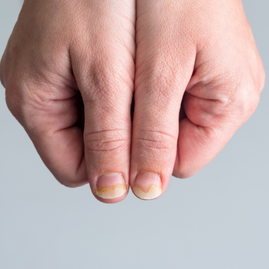 Các Bệnh Về Móng Tay: Dấu Hiệu, Nguyên Nhân Và Cách Điều Trị