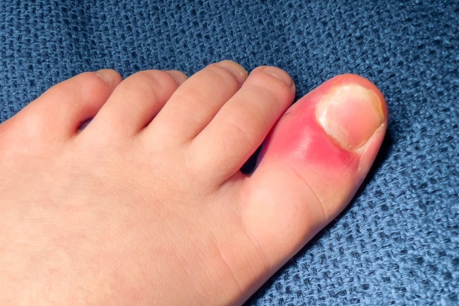 Bạn cần đến cơ sở y tế khi móng bị hư nặng