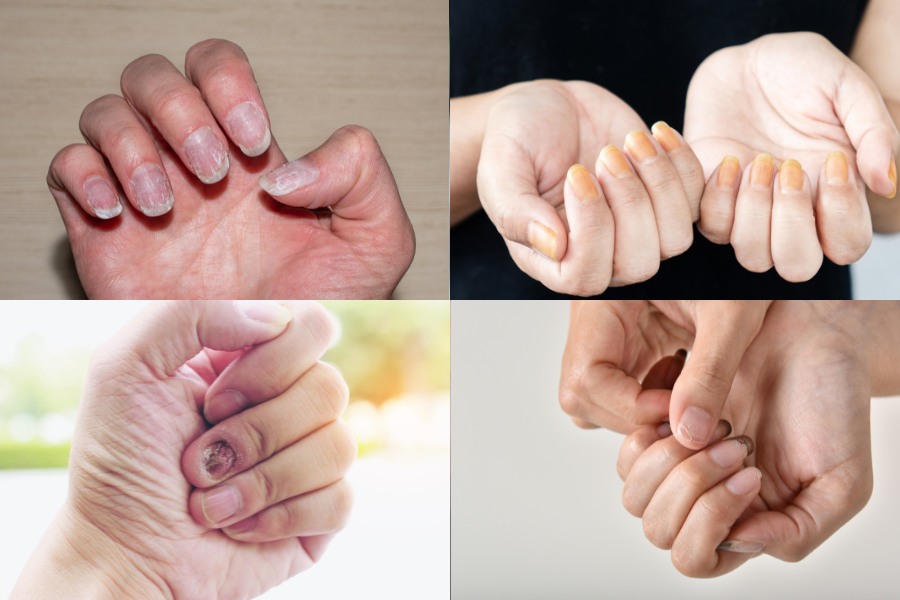 Các dấu hiệu cho thấy móng tay bạn đang bị hư tổn