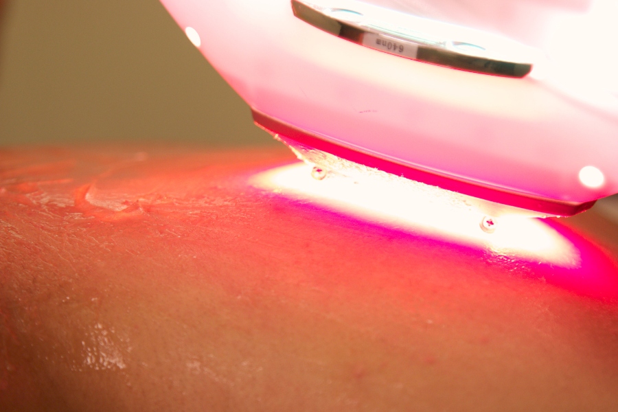 Áp dụng các liệu pháp laser trị nấm móng tay