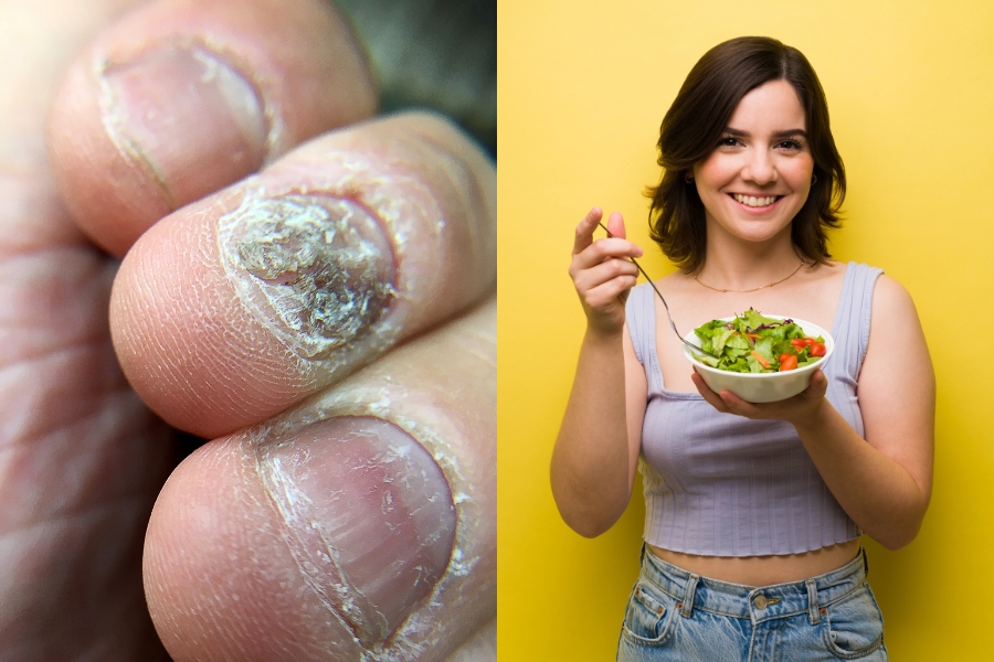 Chế độ ăn uống có liên quan chặt chẽ với rủi ro bị nấm móng