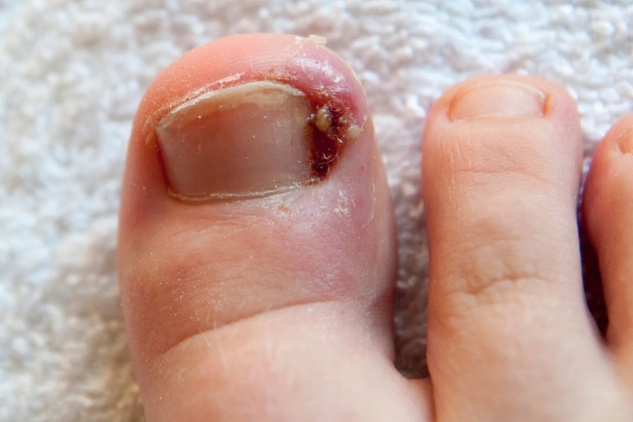 Chấn thương khiến móng chân tổn thương