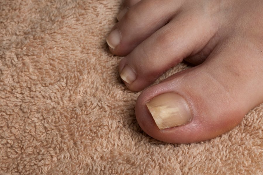 Nhận diện dấu hiệu móng chân bị hư để xử lý kịp thời