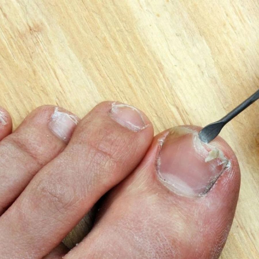 Nguyên nhân và cách xử lý móng chân bị hư đúng cách