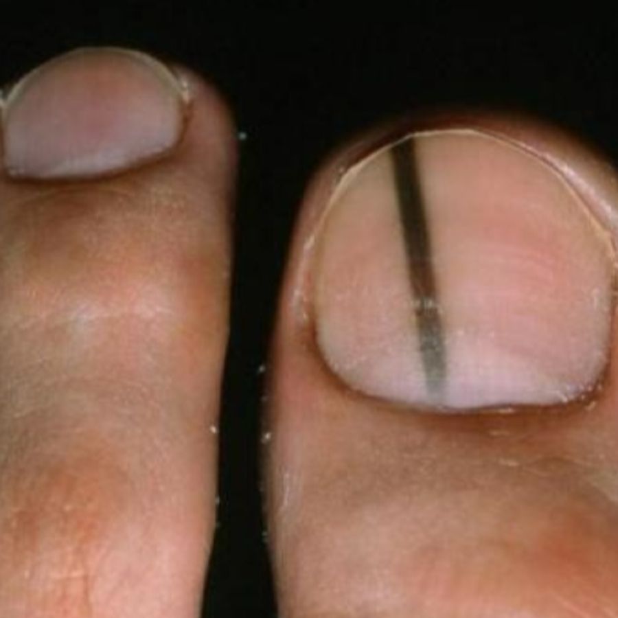 Móng chân bị sọc: Nguyên nhân, cảnh báo và cách xử lý