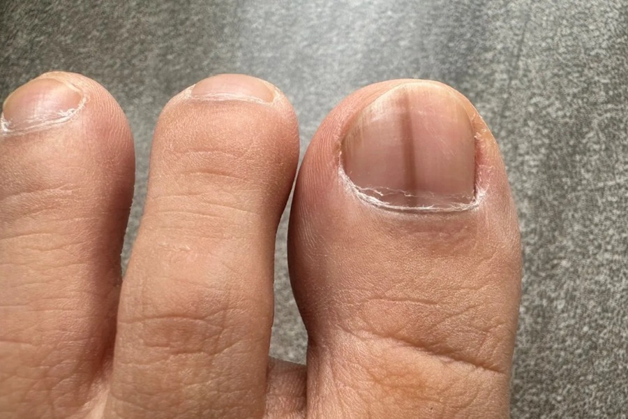 Sọc đen trên móng có thể là biểu hiện của bệnh nghiêm trọng