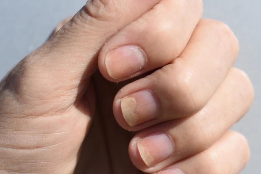 Móng bị tách khỏi giường móng là biến chứng của bệnh nấm móng