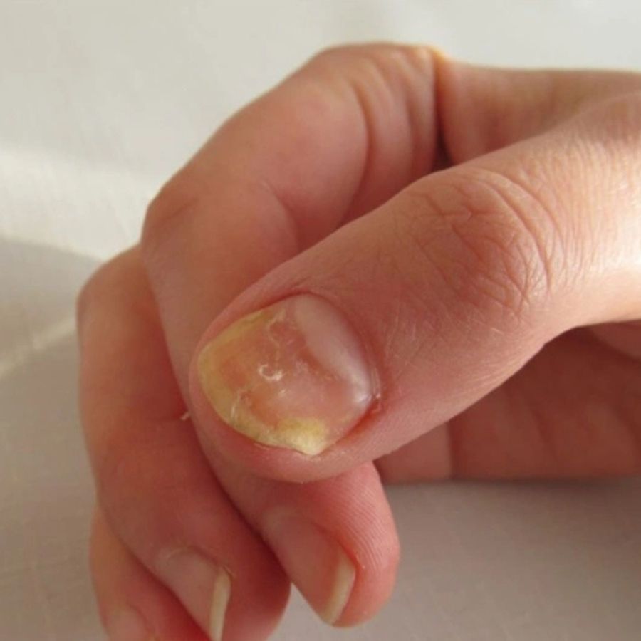 Móng tay bị vàng thiếu chất gì? 5+ nguyên nhân và cách khắc phục