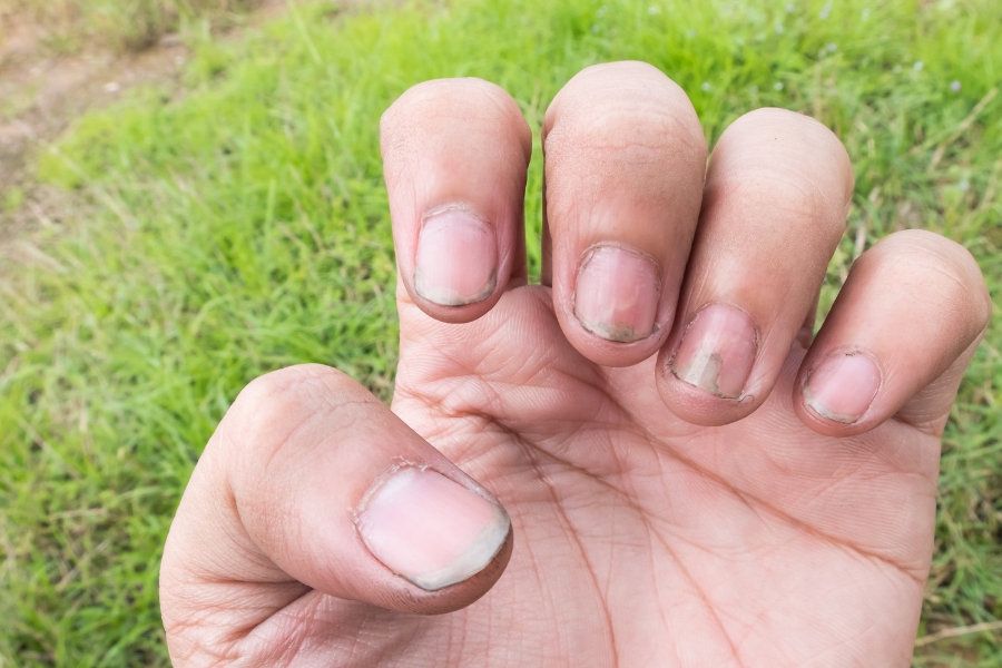 Móng tay thường đổi màu và có mùi hôi khi bị nấm