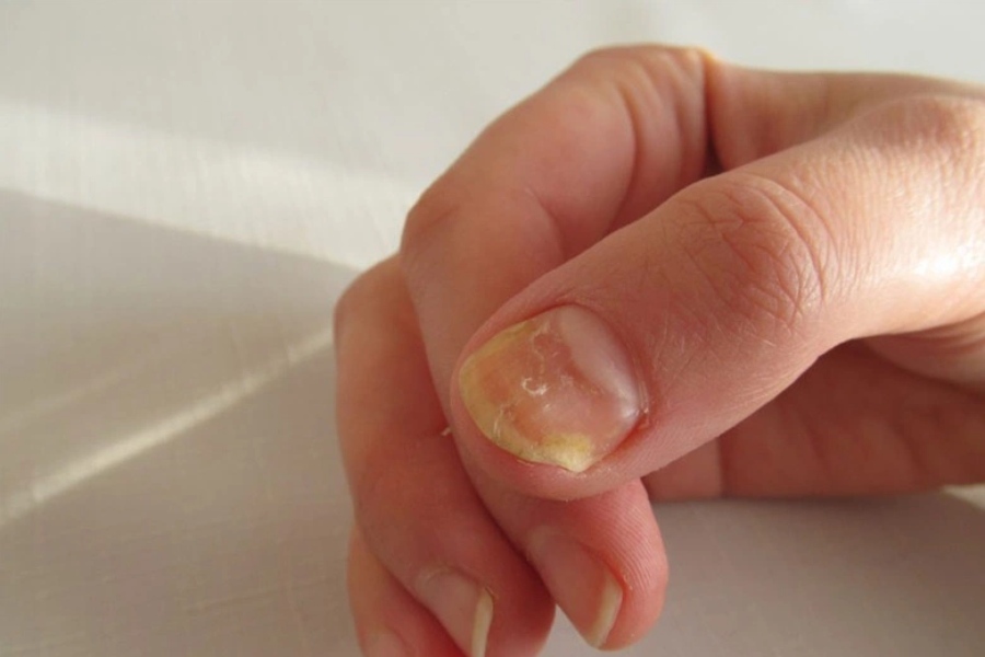 Bạn nên đến bác sĩ thăm khám khi móng tay thay đổi màu sắc và hình dạng