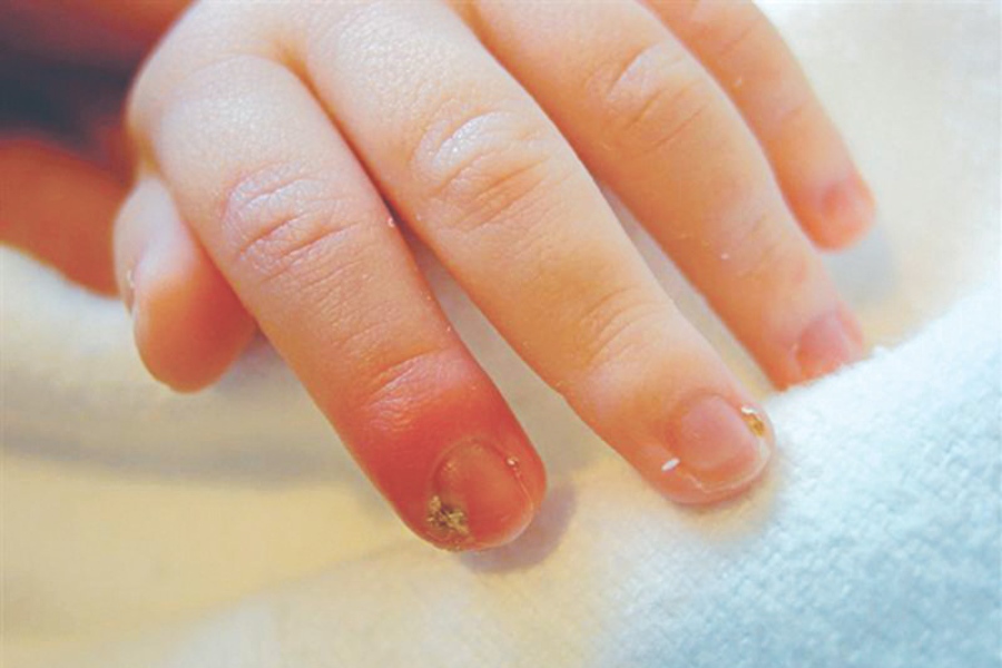 Móng tay mọc ngược nếu không được xử lý đúng có thể gây nhiễm trùng