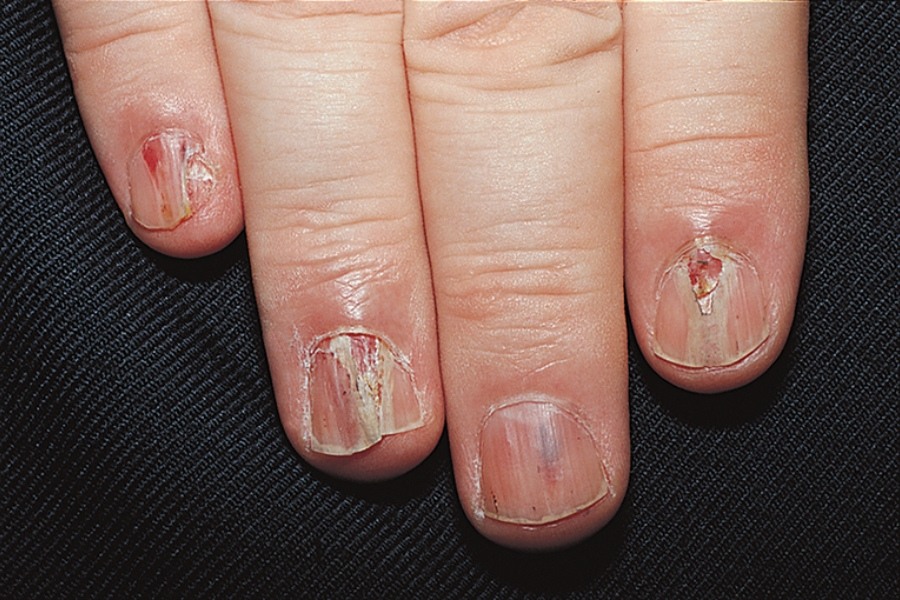 Các loại nấm ký sinh làm cho bóng tay bạn trở nên hư tổn mất thẩm mỹ