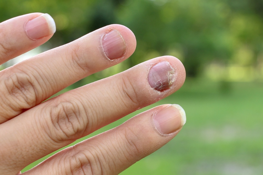 Nấm móng tay làm thay đổi vẻ ngoài và cấu trúc móng