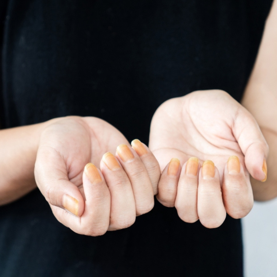 Nấm Móng Tay: Dấu Hiệu, Nguyên Nhân & Hướng Điều Trị