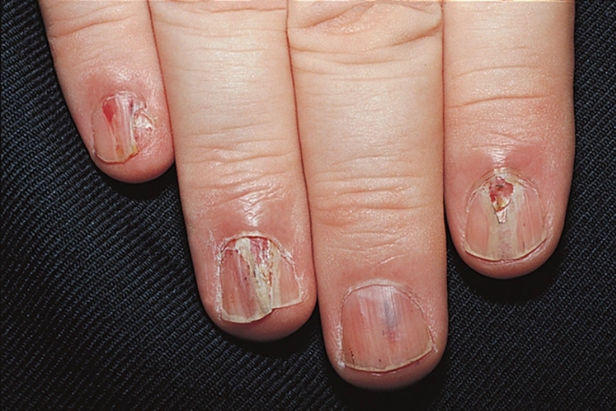 Thường mất 6 - 12 tháng để có thể trị khỏi hoàn toàn nấm móng