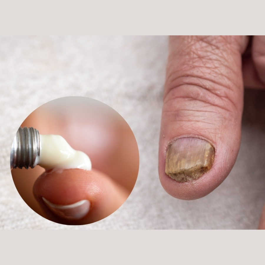 Nấm móng tay bôi thuốc gì? Top thuốc bôi hiệu quả được bác sĩ khuyên dùng