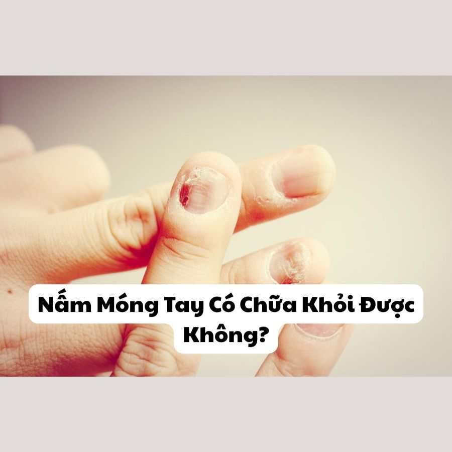 Nấm Móng Tay Có Chữa Khỏi Được Không? [Chuyên Gia Giải Đáp]