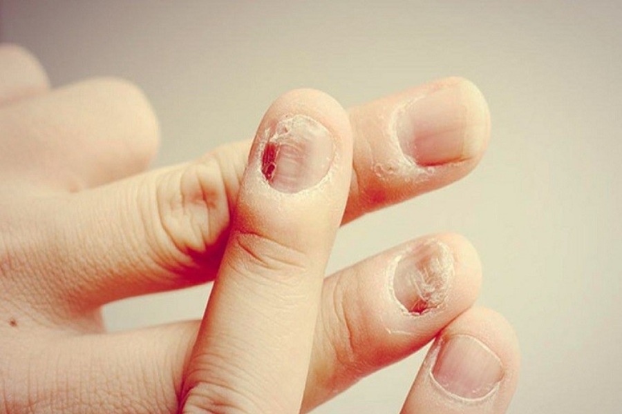 Nấm móng có thể tái phát nếu người bệnh chủ quan