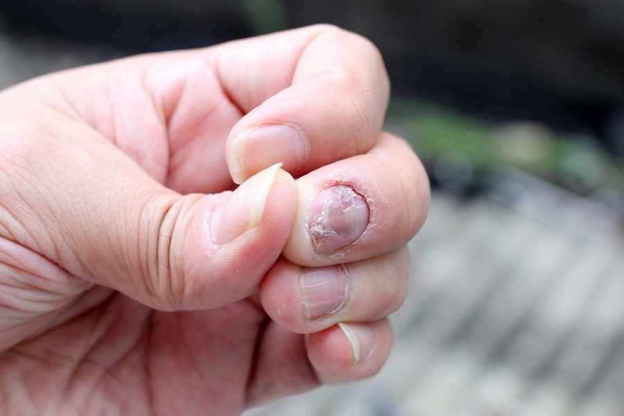 Nấm móng tay là bệnh lý phổ biến, xảy ra chủ yếu do thói quen sinh hoạt