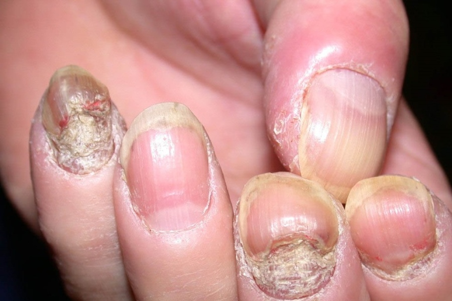 Nấm móng tay là bệnh khá phổ biến