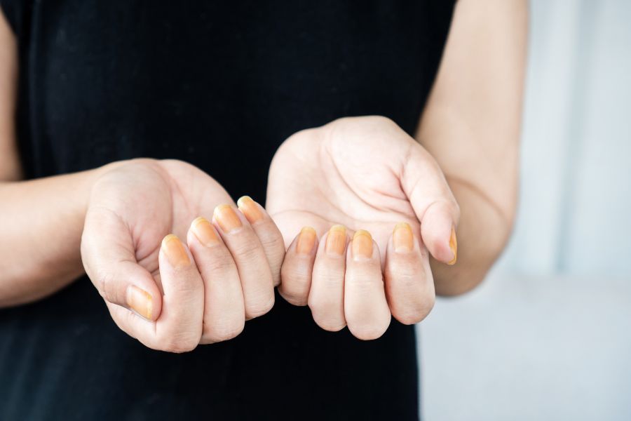 Móng tay xỉn màu và yếu đi do nhiều yếu tố tác động