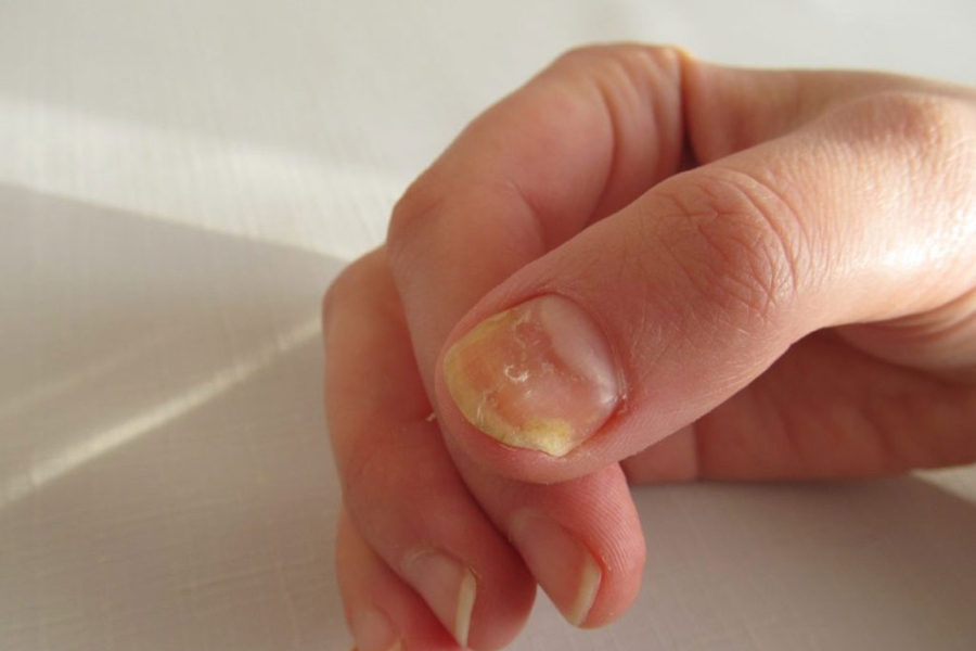Nhận biết móng bị vàng qua màu sắc