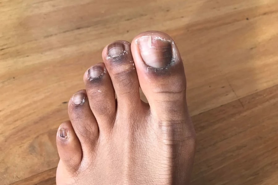 U hắc tố dưới móng là bệnh nguy hiểm cần đặc biệt lưu ý