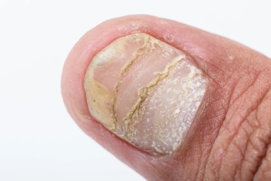 Vảy nến là bệnh tự miễn gây mất thẩm mỹ cho đôi bàn tay